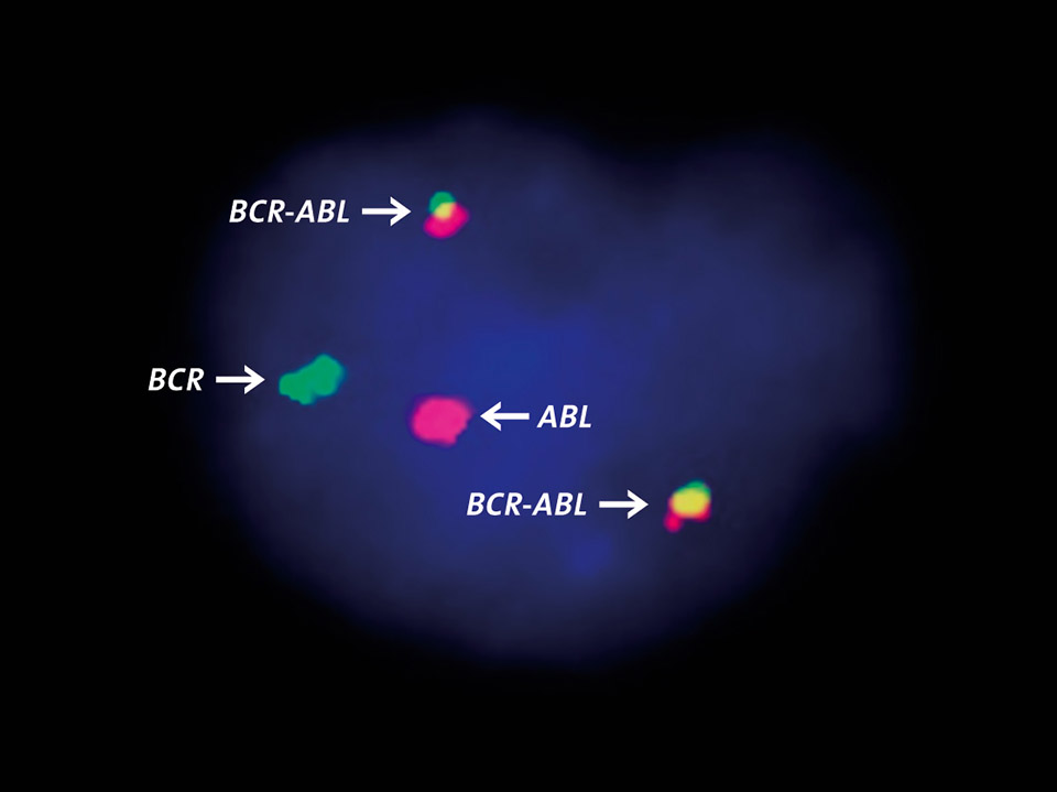 BCR-ABL fusion gene detected by fluorescence-in-situ-hybridisation