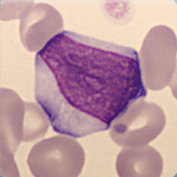 Atypical lymphocytes suspected reactive